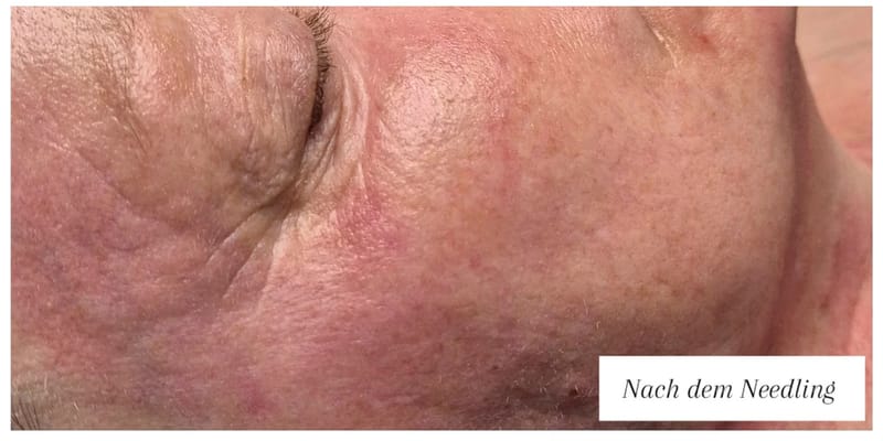 Hautbild direkt nach dem Microneedling im NAKO Institut Strausberg